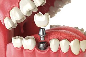 dental implants in calpe
