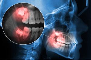 wisdom teeth extraction in calpe