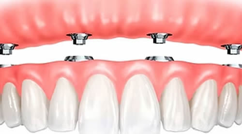 Clinica del Pino -Cirugia Oral e Implantes - Implantes Dentales 2