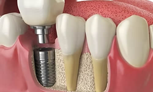 Clinica del Pino -Cirugia Oral e Implantes - Implantes Dentales