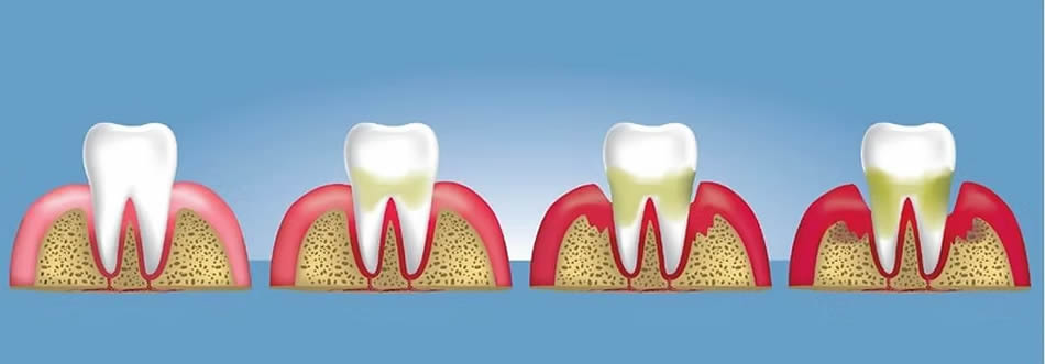 Clinica del Pino - Periodoncia - Enfermedad Periodontal