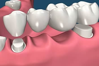 Clinica del Pino - Protesis Fija y Removible - Puentes Dentales