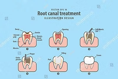 Clinica del Pino - Conservadora - Endodoncia