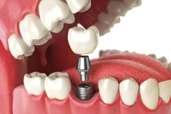 implantes dentales en calpe