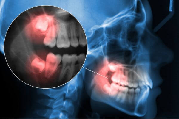 wisdom teeth extraction in calpe wisdom teeth extraction in calpe
